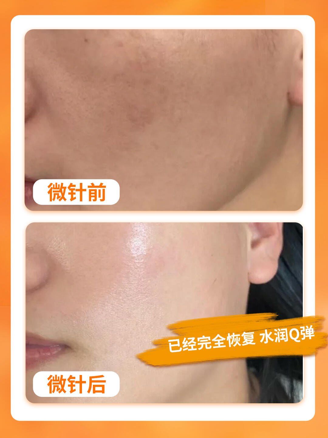 做完微针要注意些什么