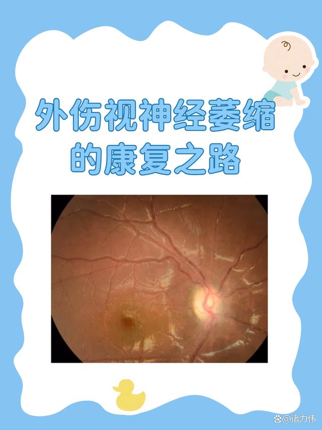 什么是球后视神经炎?