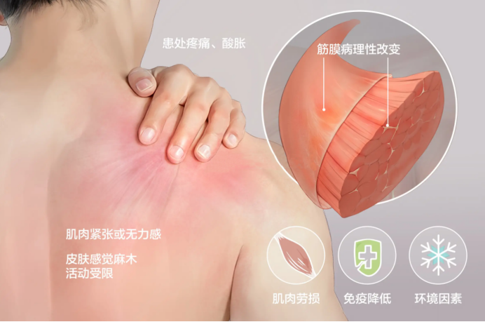 肌肉粘连怎么治疗