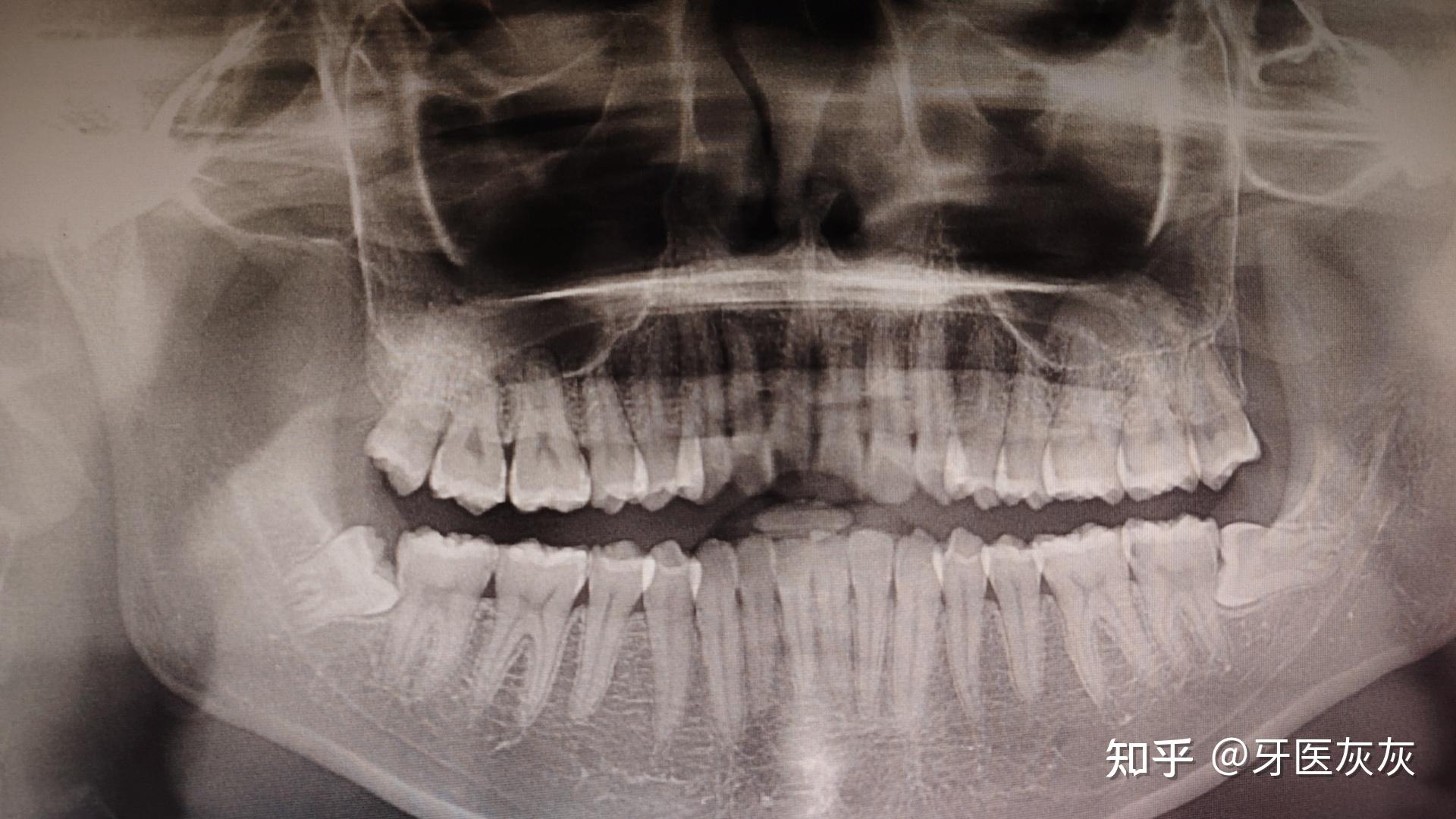 拔一个阻生齿大概多少钱