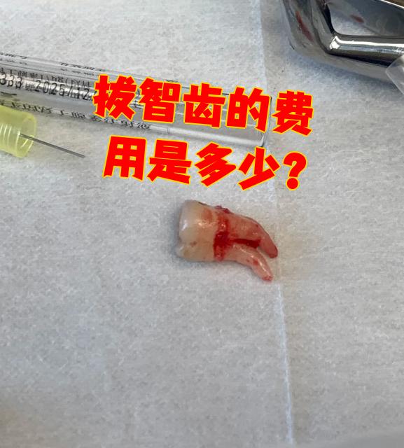 拔一个阻生齿大概多少钱