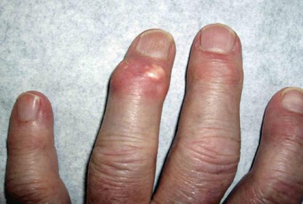 痛风的前兆有什么症状