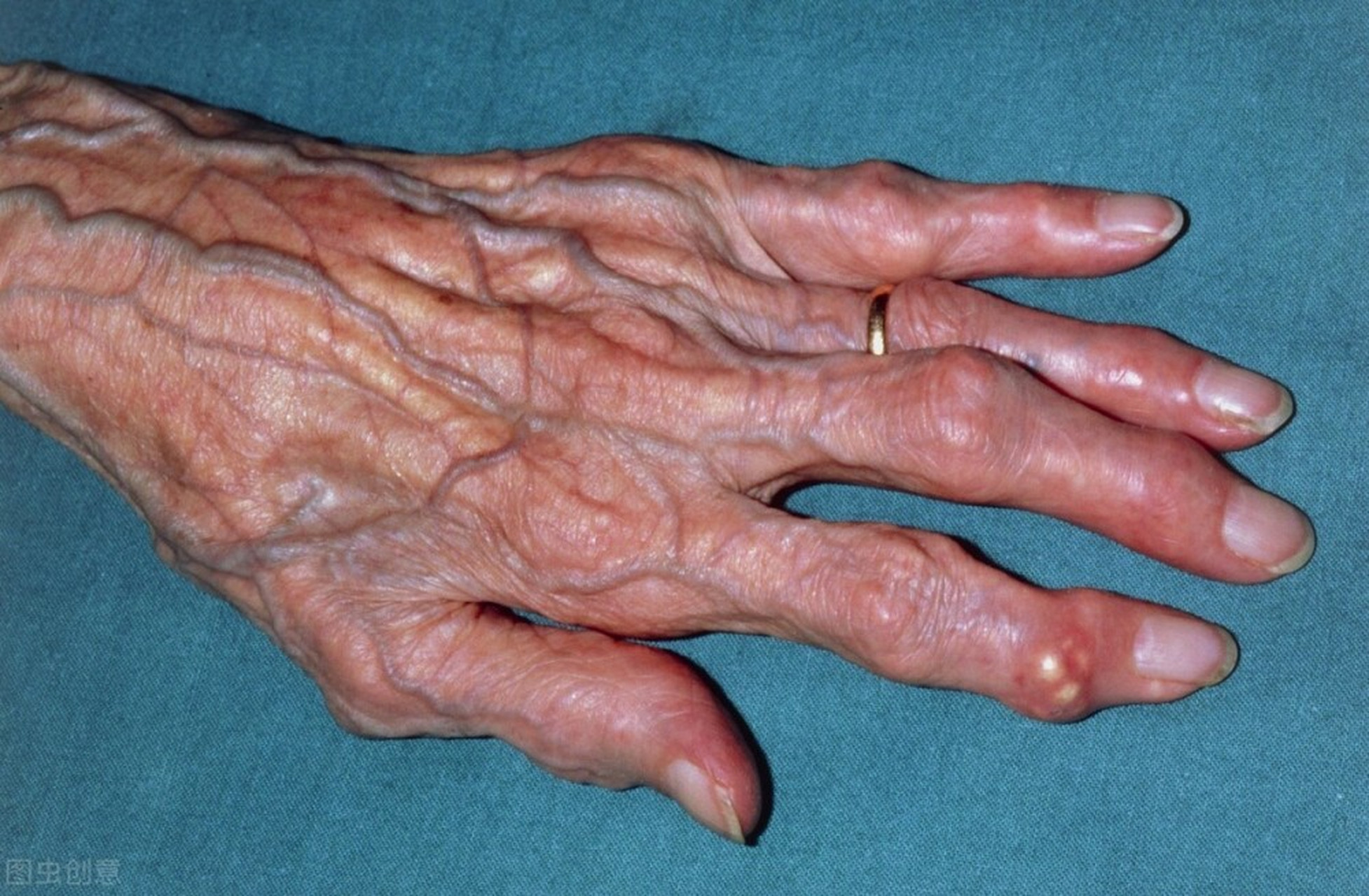 痛风的前兆有什么症状