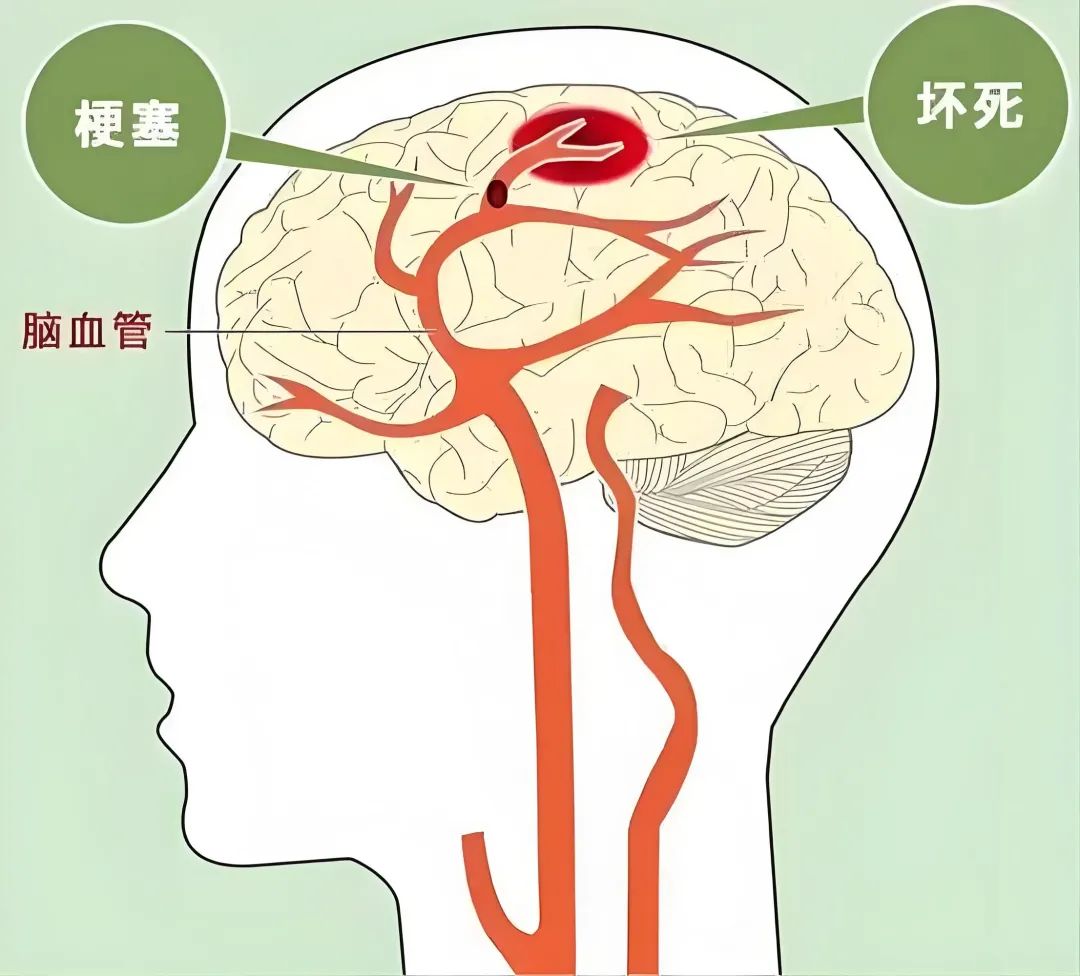 脑部供血不足的症状有哪些