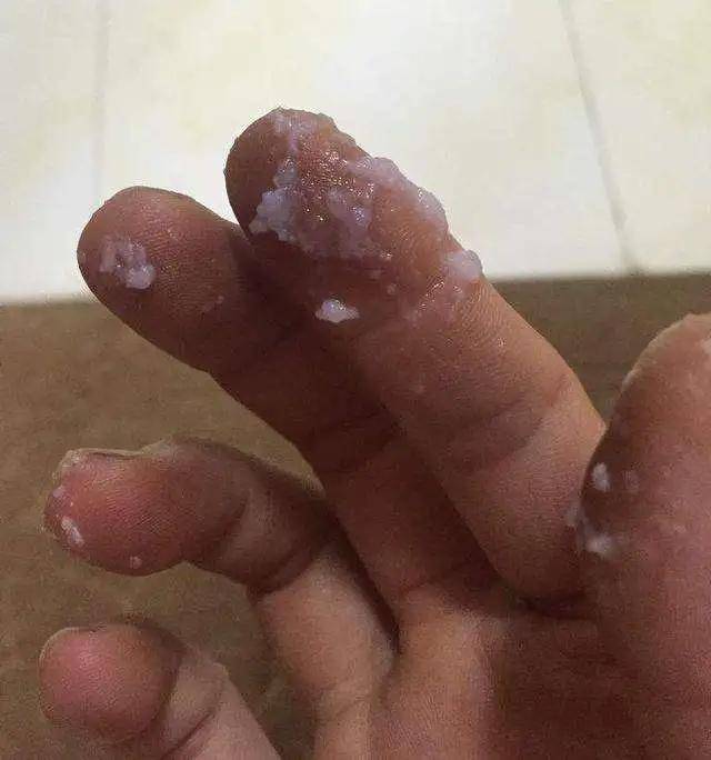 霉菌性阴道炎会传染吗