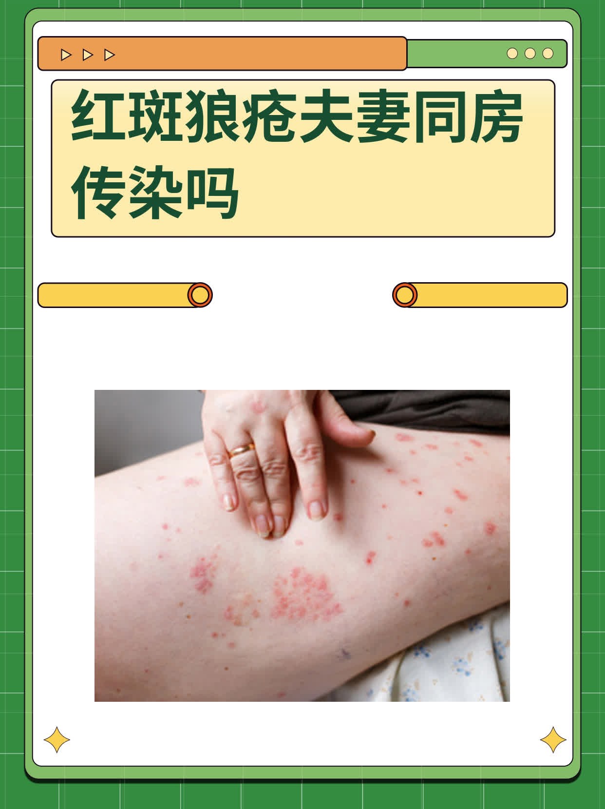 红斑狼疮的病因有哪些?