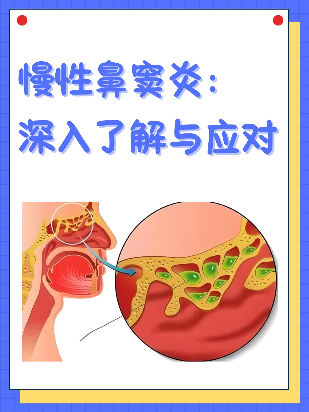 慢性鼻炎会癌变吗