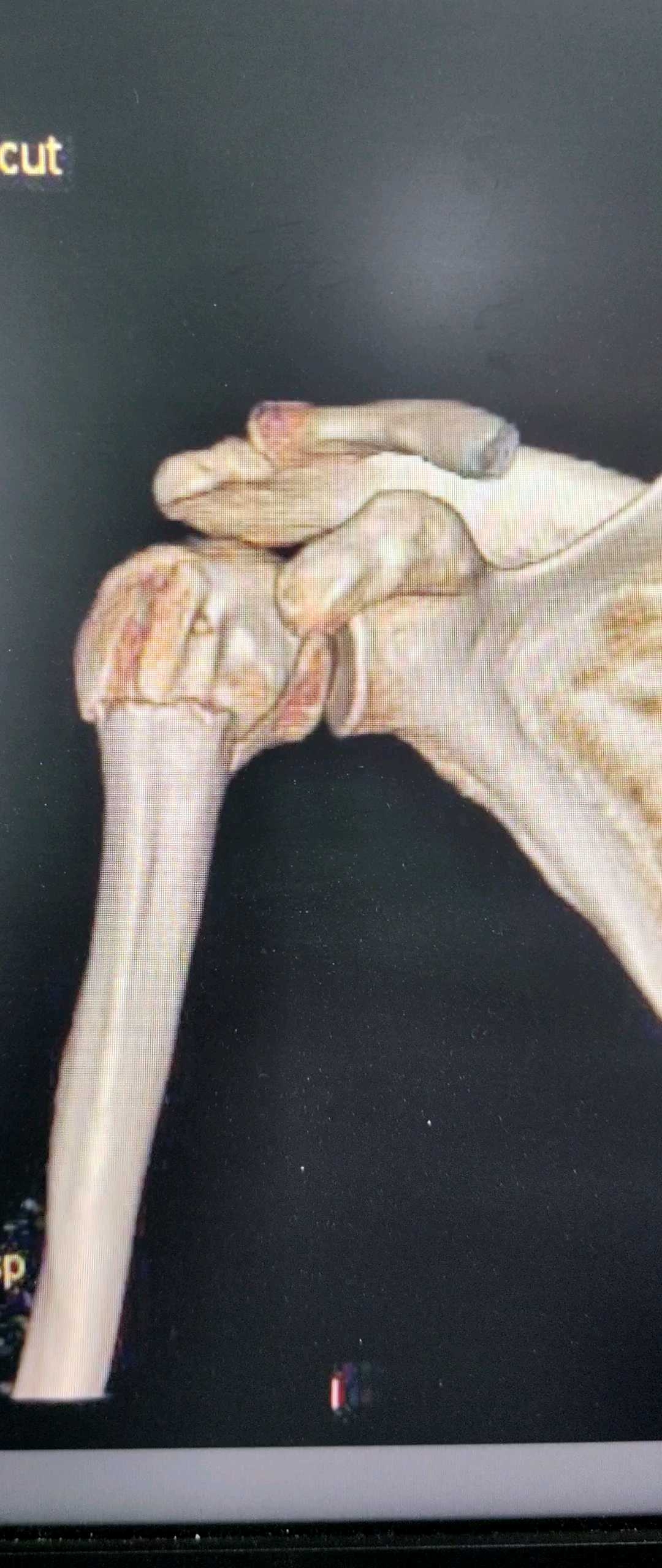 什么是肱骨外科颈骨折