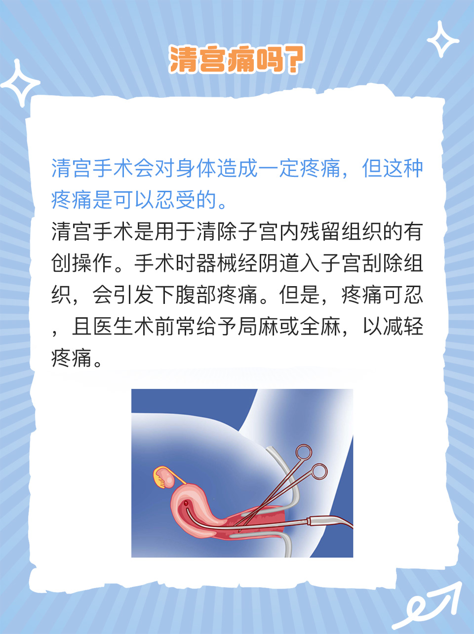 药流后要清宫吗