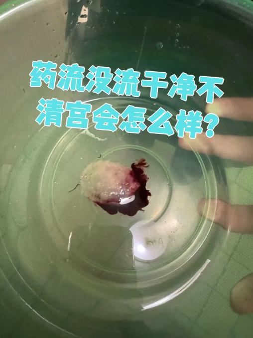药流后要清宫吗