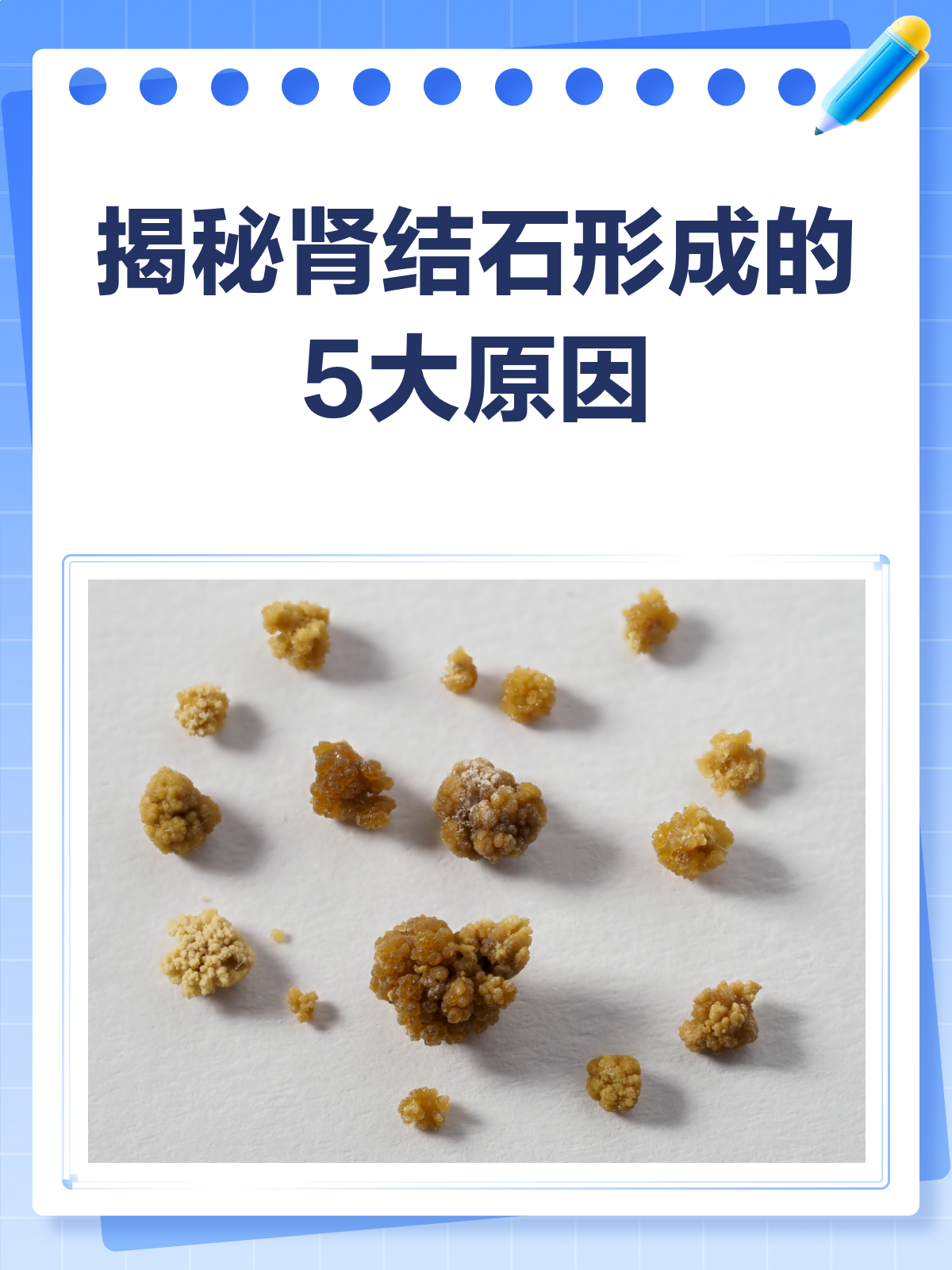 肾结石体外碎石对身体危害大吗