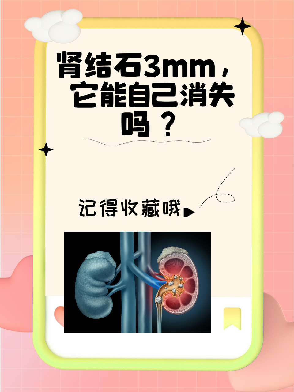 肾结石体外碎石对身体危害大吗