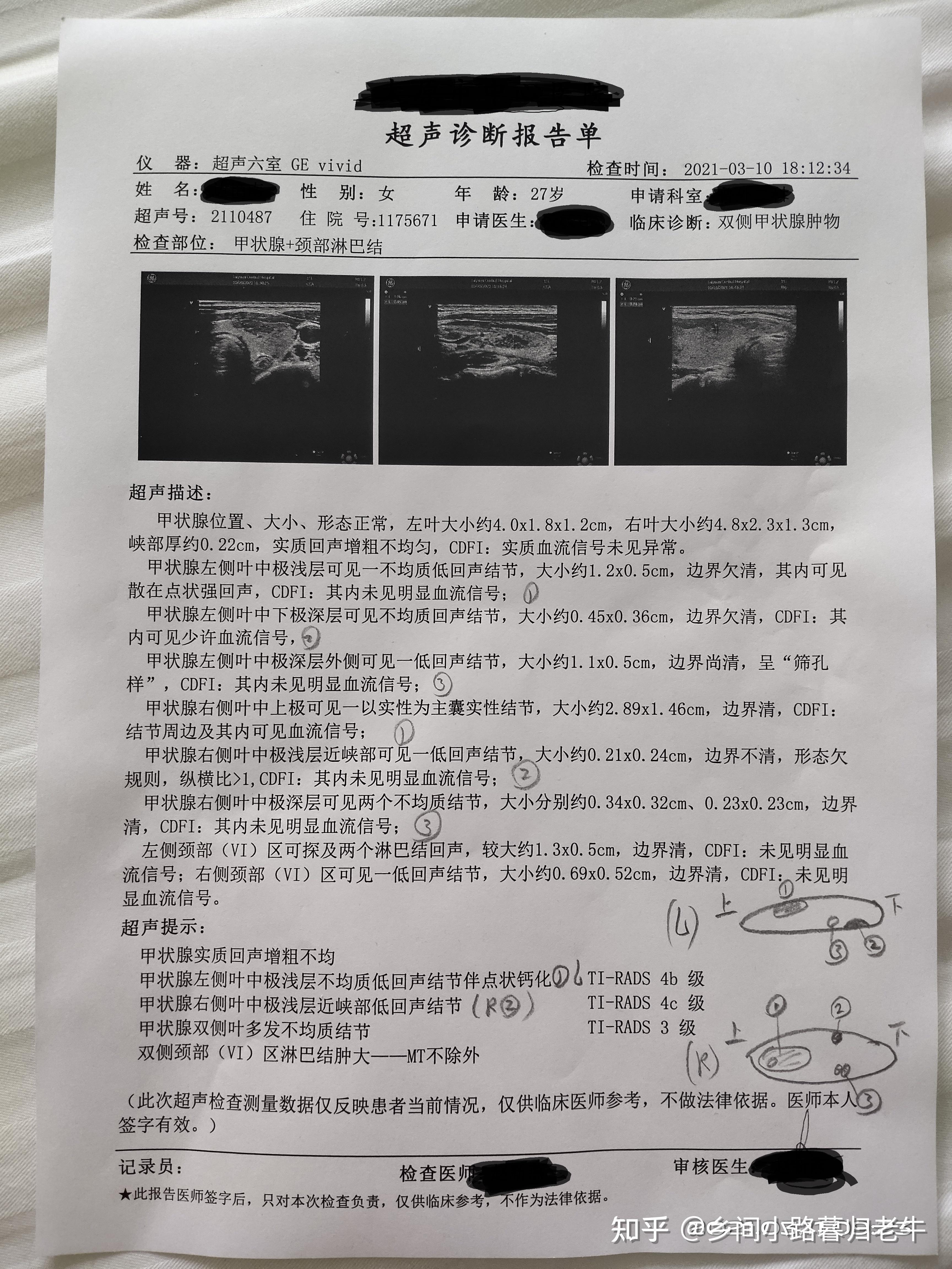 甲状腺癌的超声表现