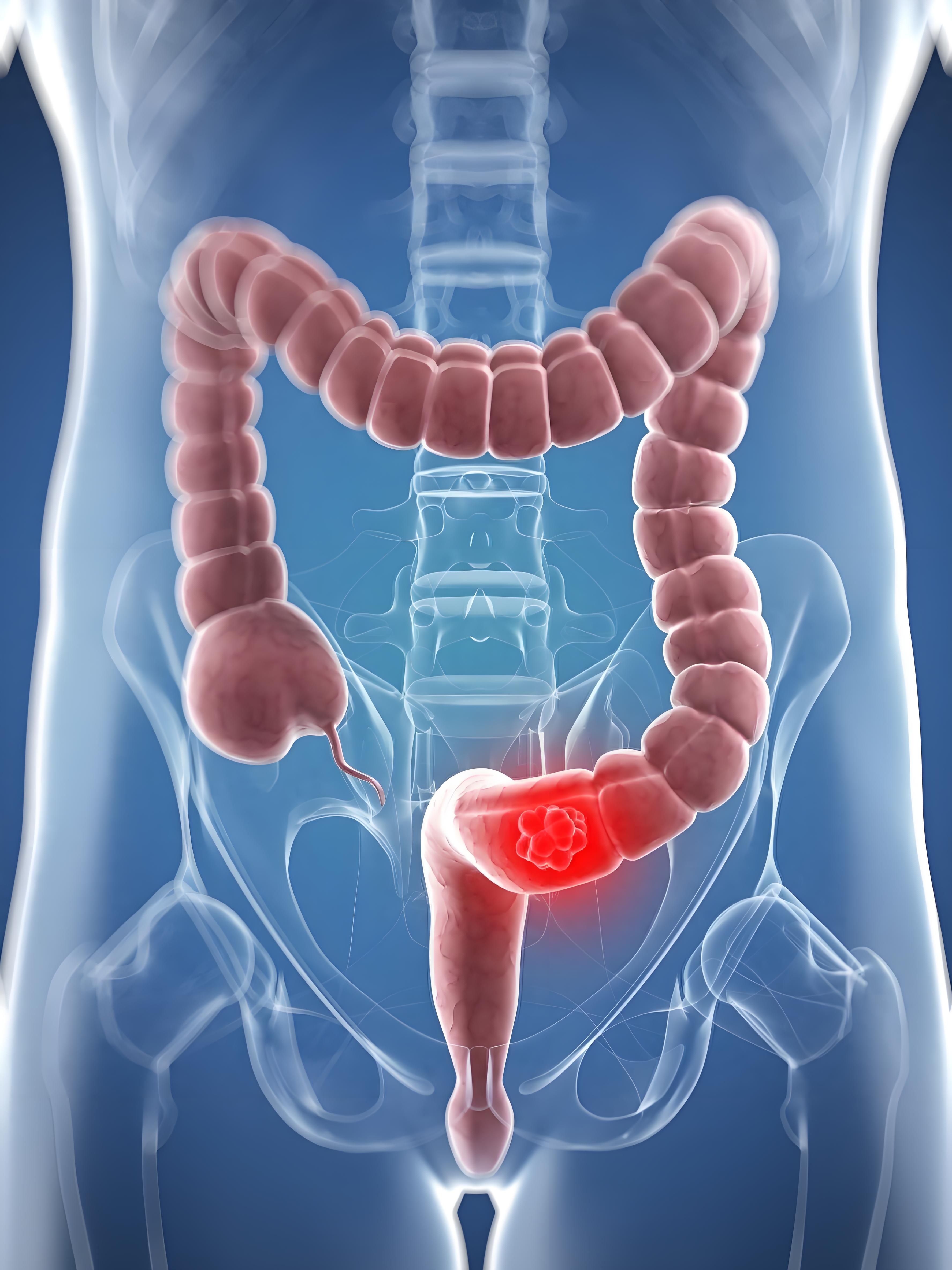 胃肠道肿瘤早期症状