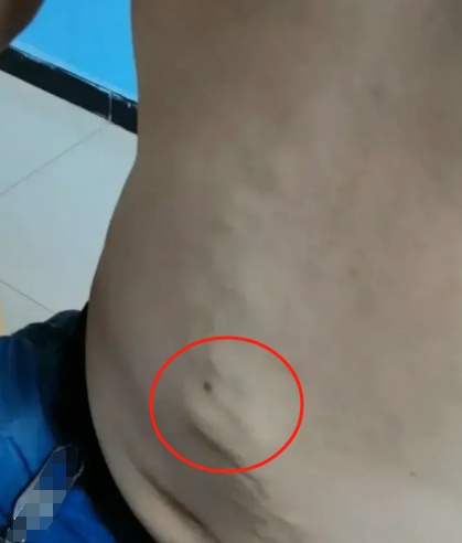 胃肠道肿瘤早期症状