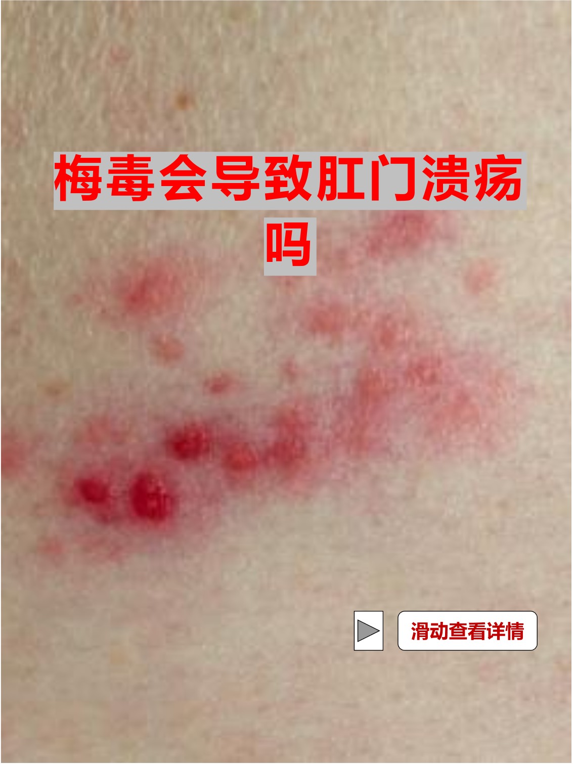 这是梅毒的硬下疳吗?第一张照片是肛门处