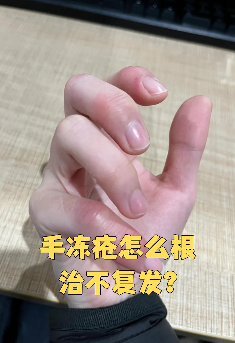 手冻肿了,该如何快速消肿?