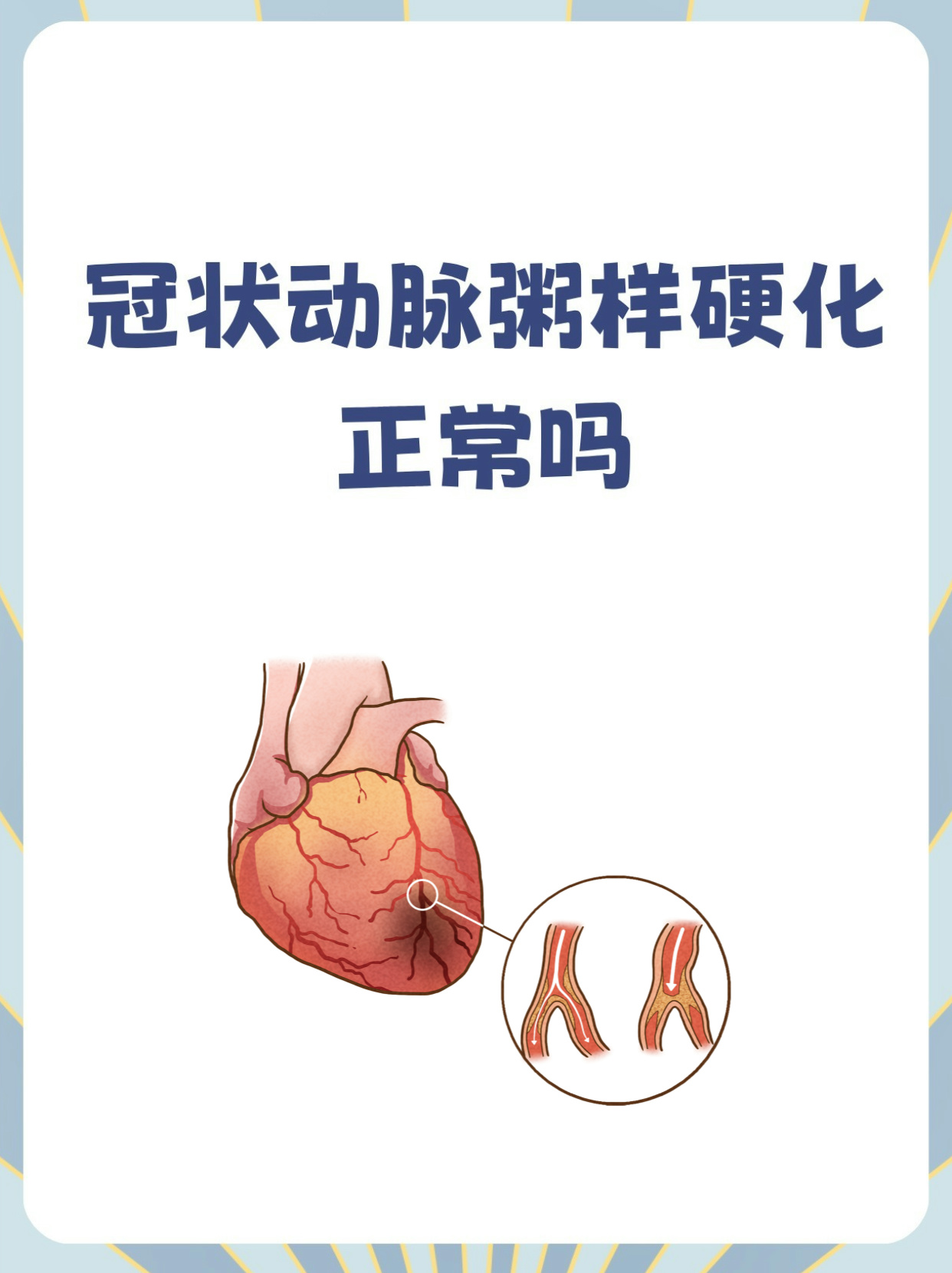 动脉粥样硬化能治愈吗