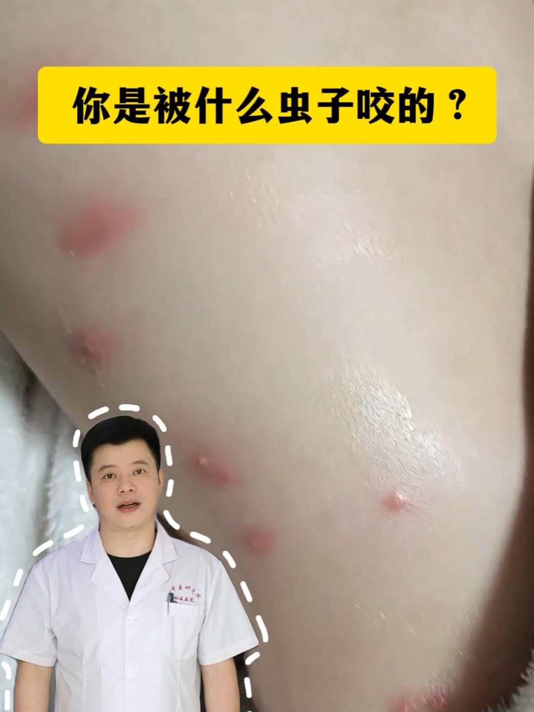 被毛毛虫蛰了怎么治疗