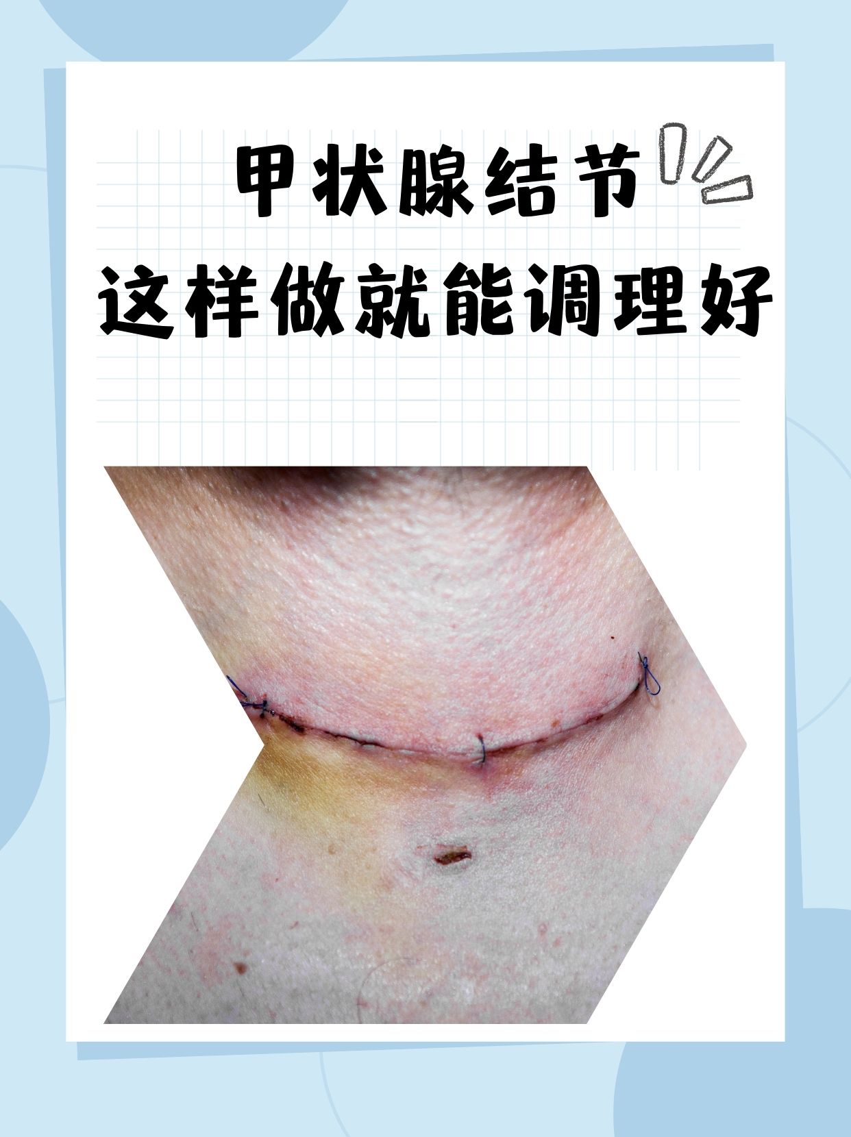 甲状腺结节可以治好吗