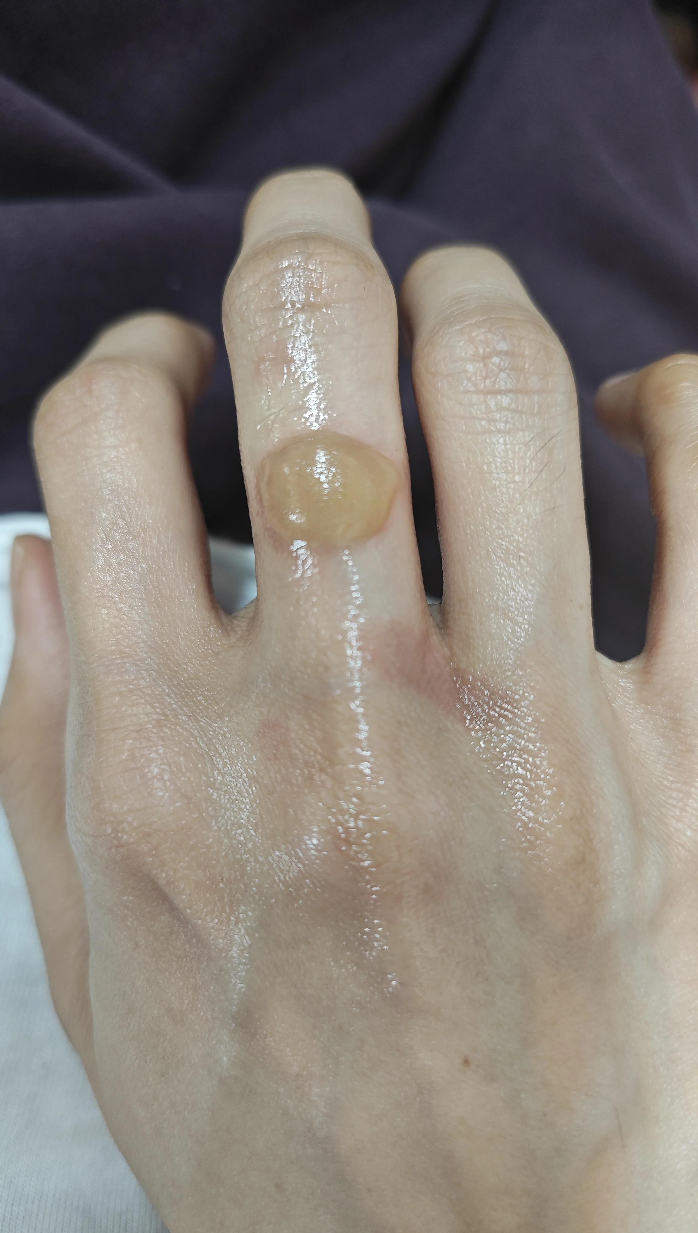 轻度烫伤起水泡要不要弄破