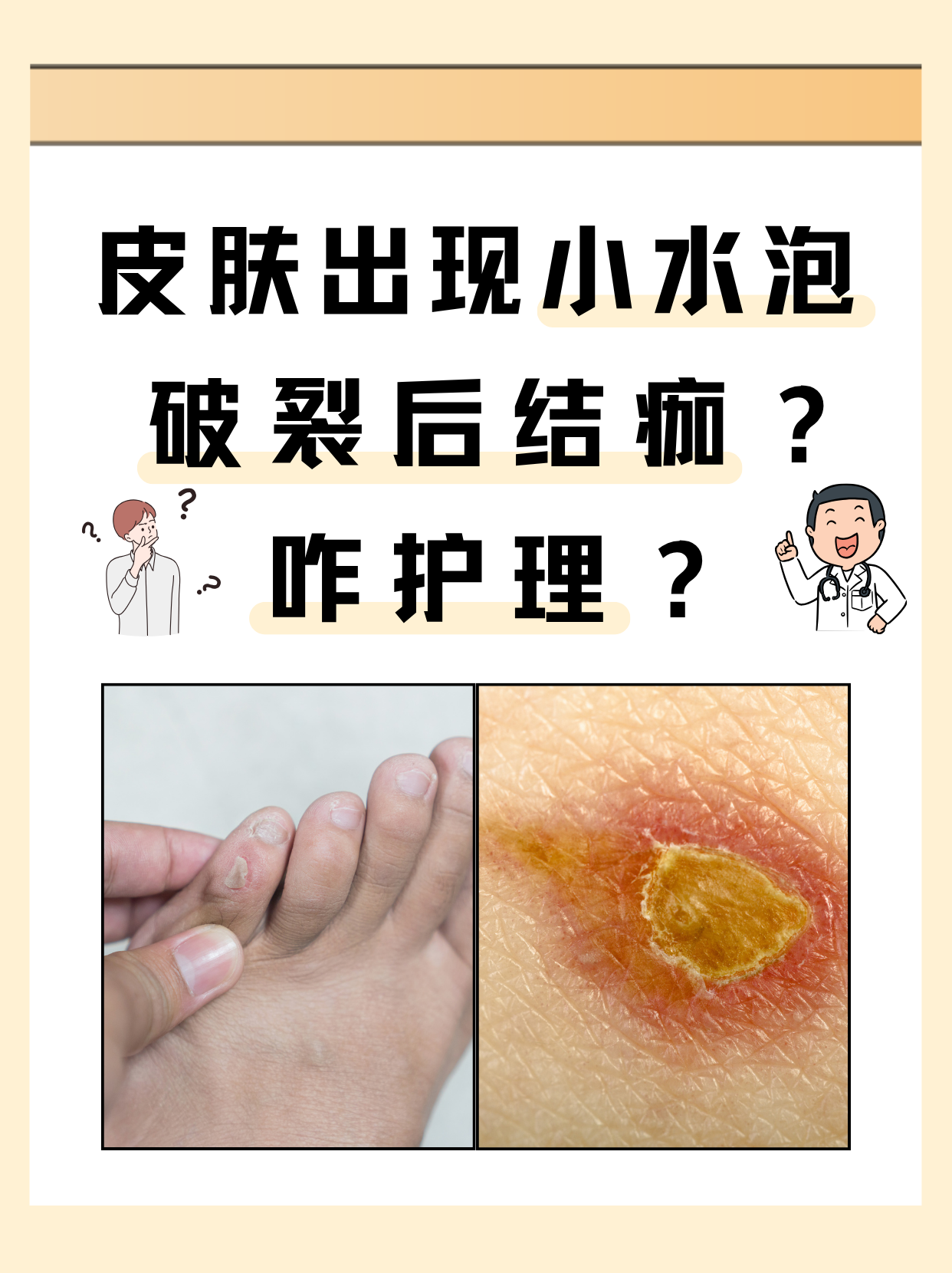 轻度烫伤起水泡要不要弄破