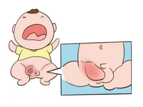 小肠气是什么病?