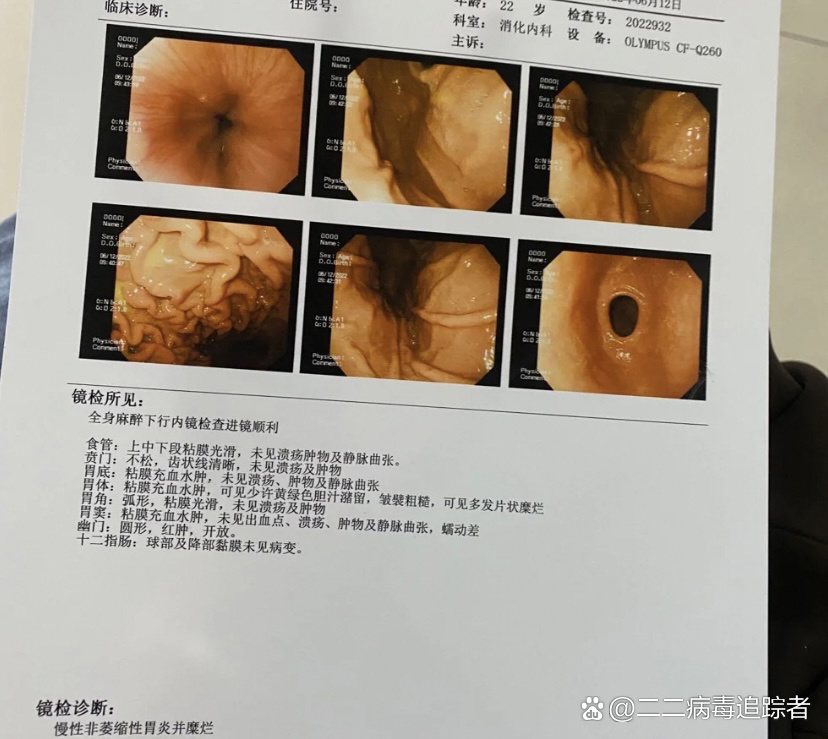 非萎缩性胃炎严重吗