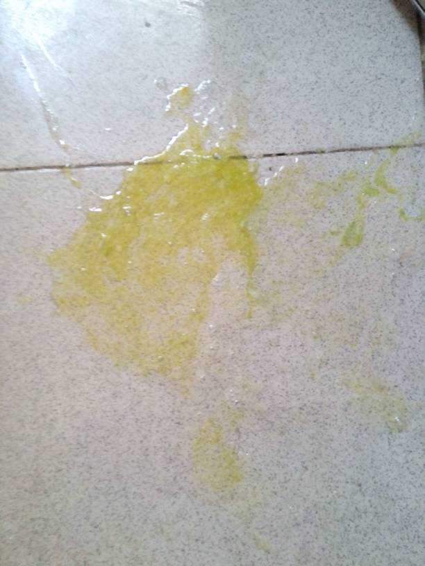 小孩反复呕吐,吐出黄水