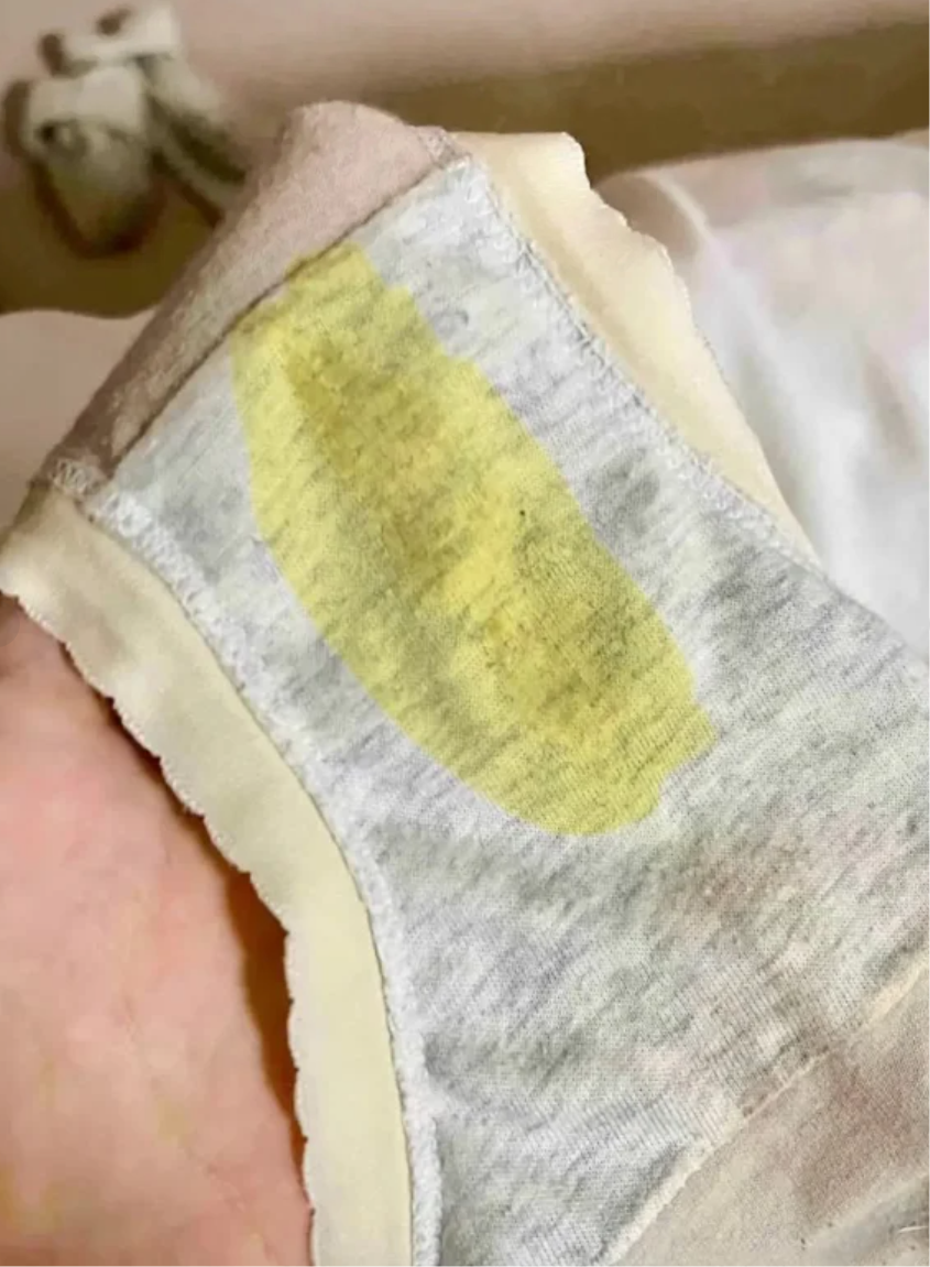 为什么白带里有血丝