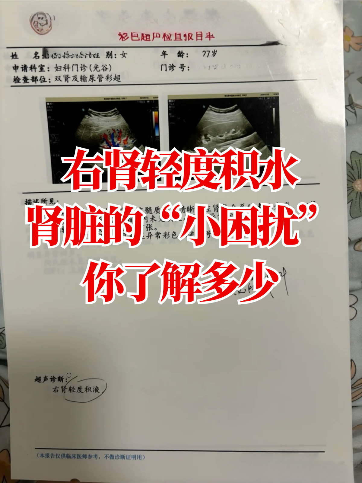 腹水怎么排出体外?