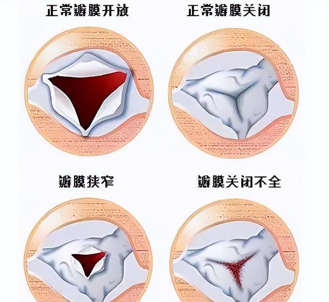 二尖瓣狭窄是什么意思