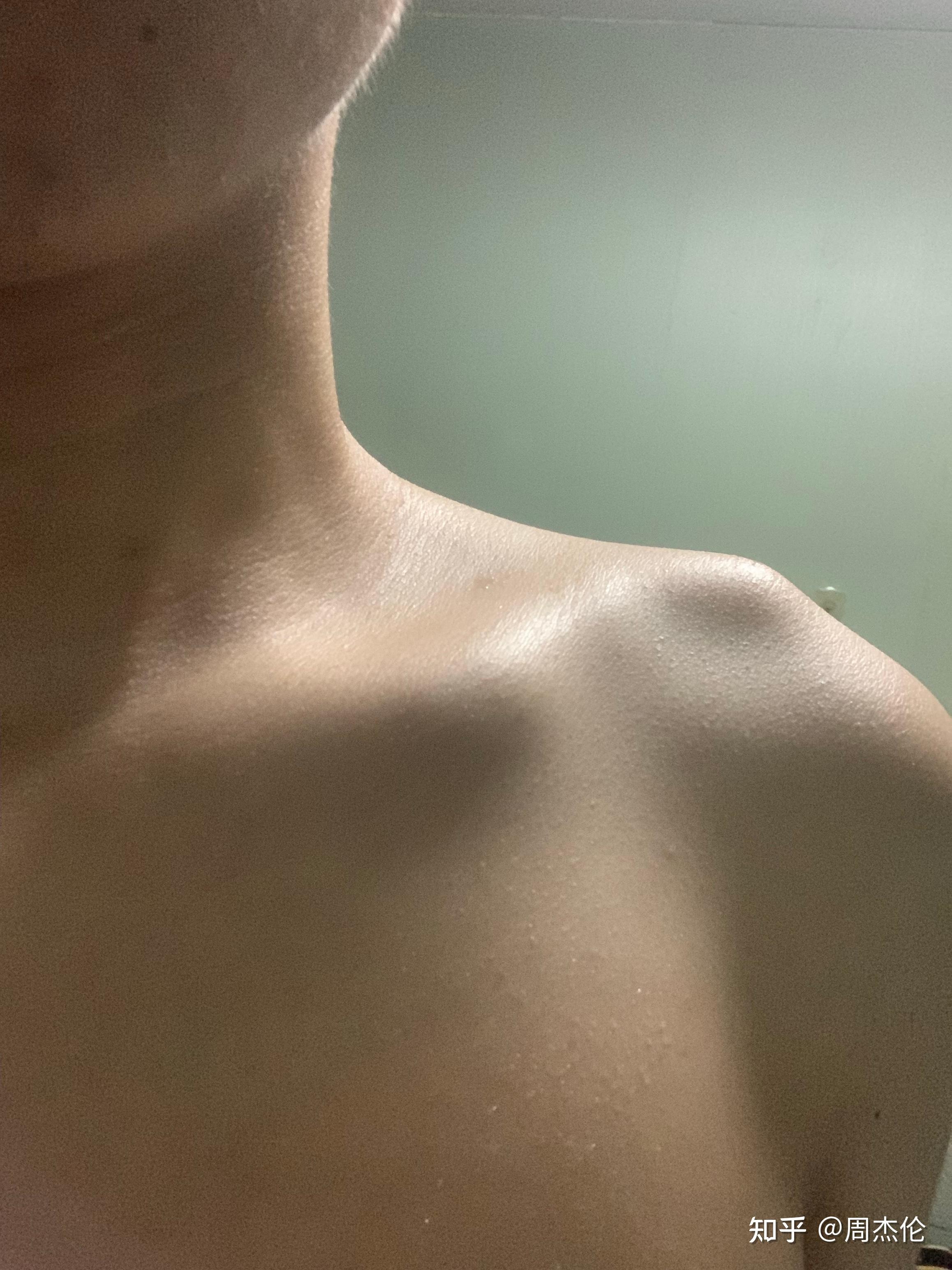 左肩膀骨头突出