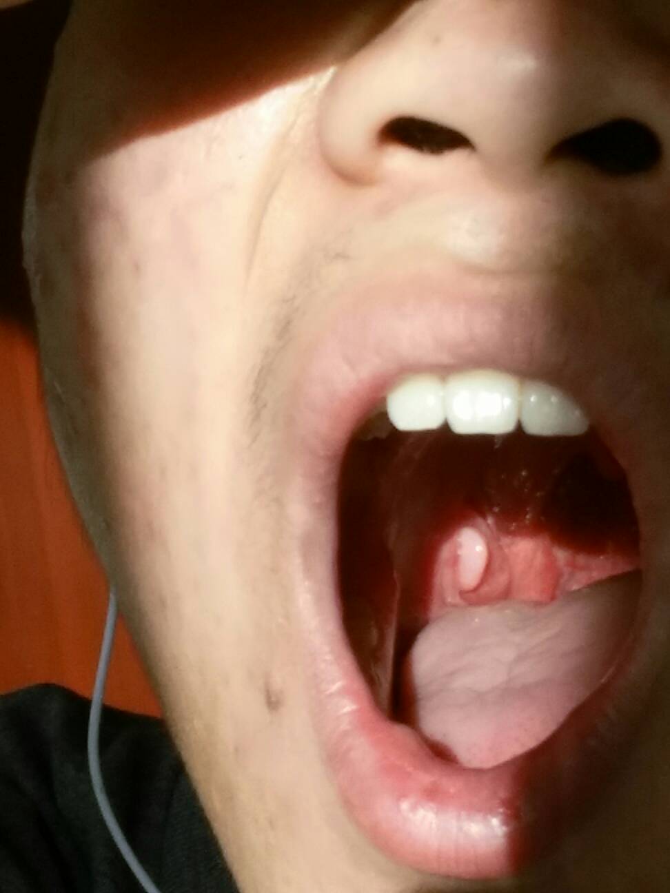 口腔内壁长了个肉疙瘩