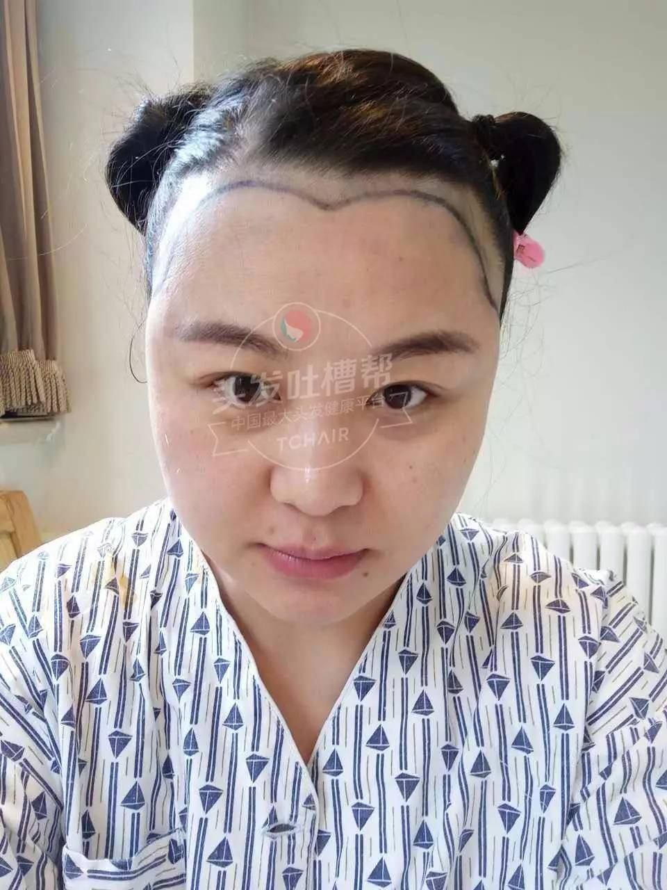 请问医生,美人尖是什么意思