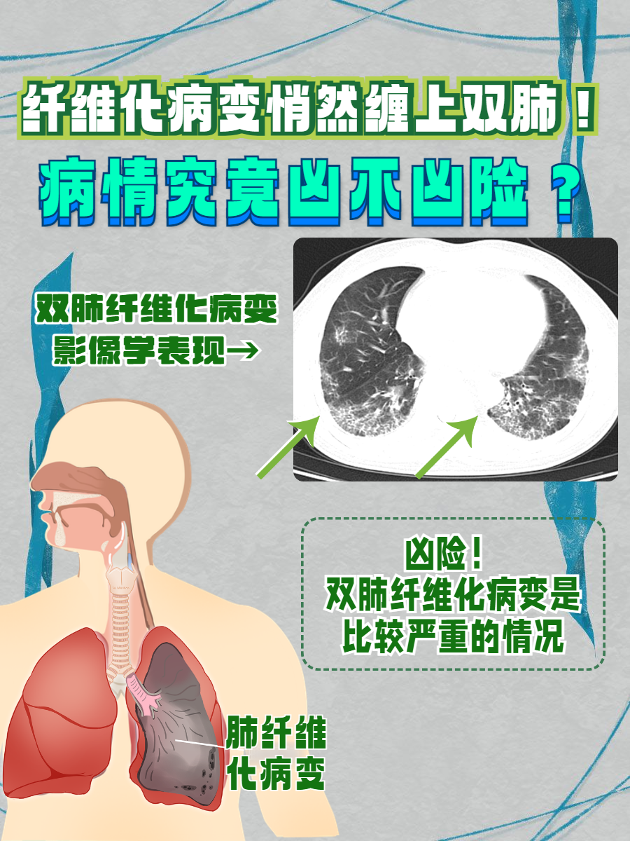 肺部纤维化能活多久