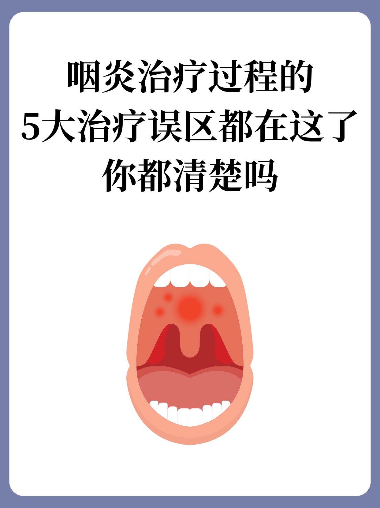 咽炎可以传染吗