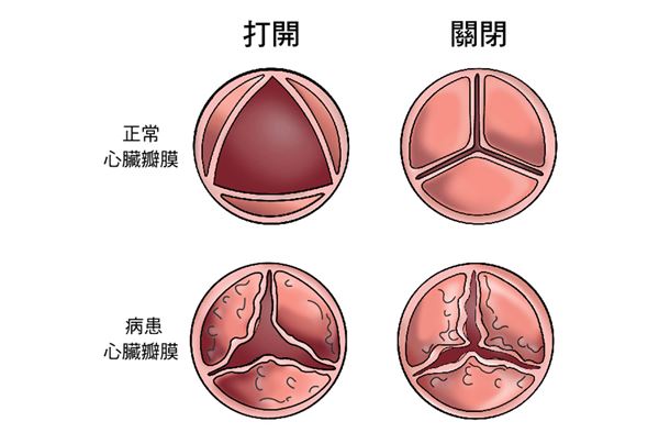 风湿性心脏病怎么引起的