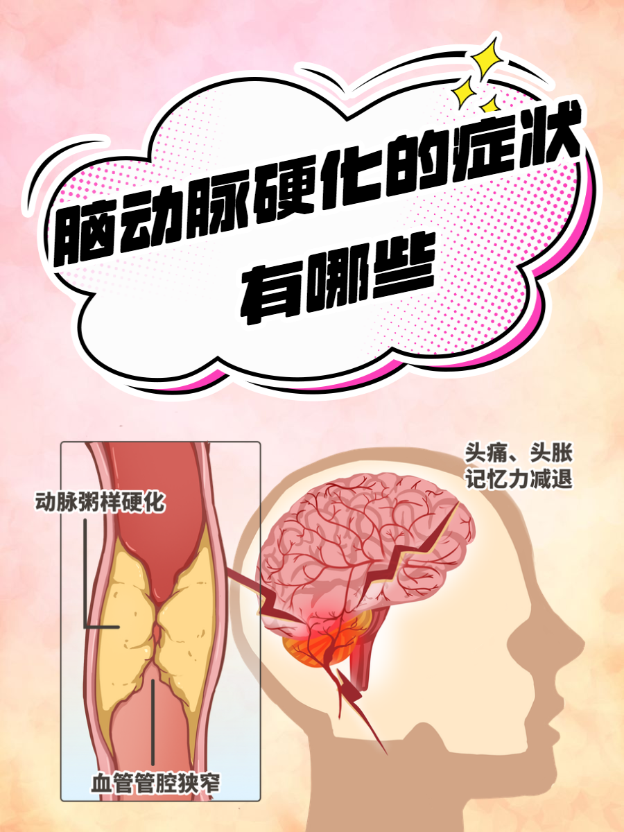 脑血管狭窄的原因