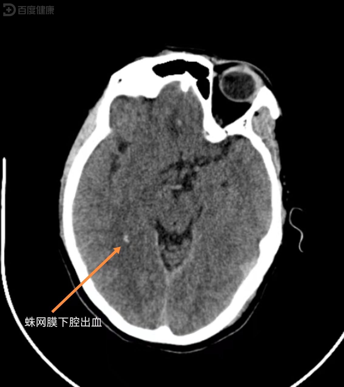 蛛网膜下腔出血是什么?