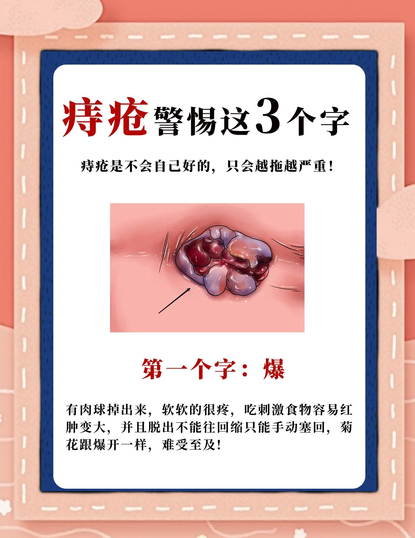 长痔疮的原因是些什么?