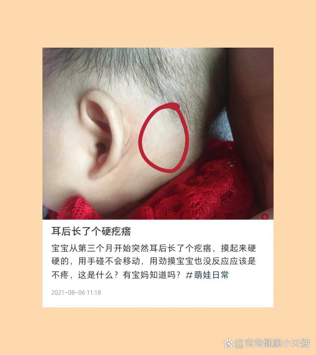 宝宝耳朵后面有个小疙瘩是怎么回事