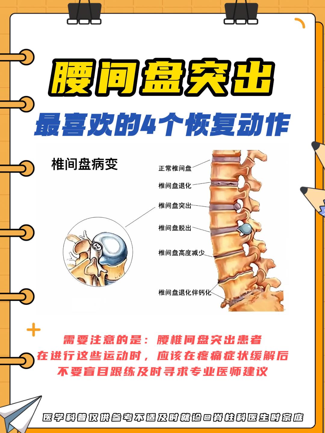 腰肌劳损可以根治吗