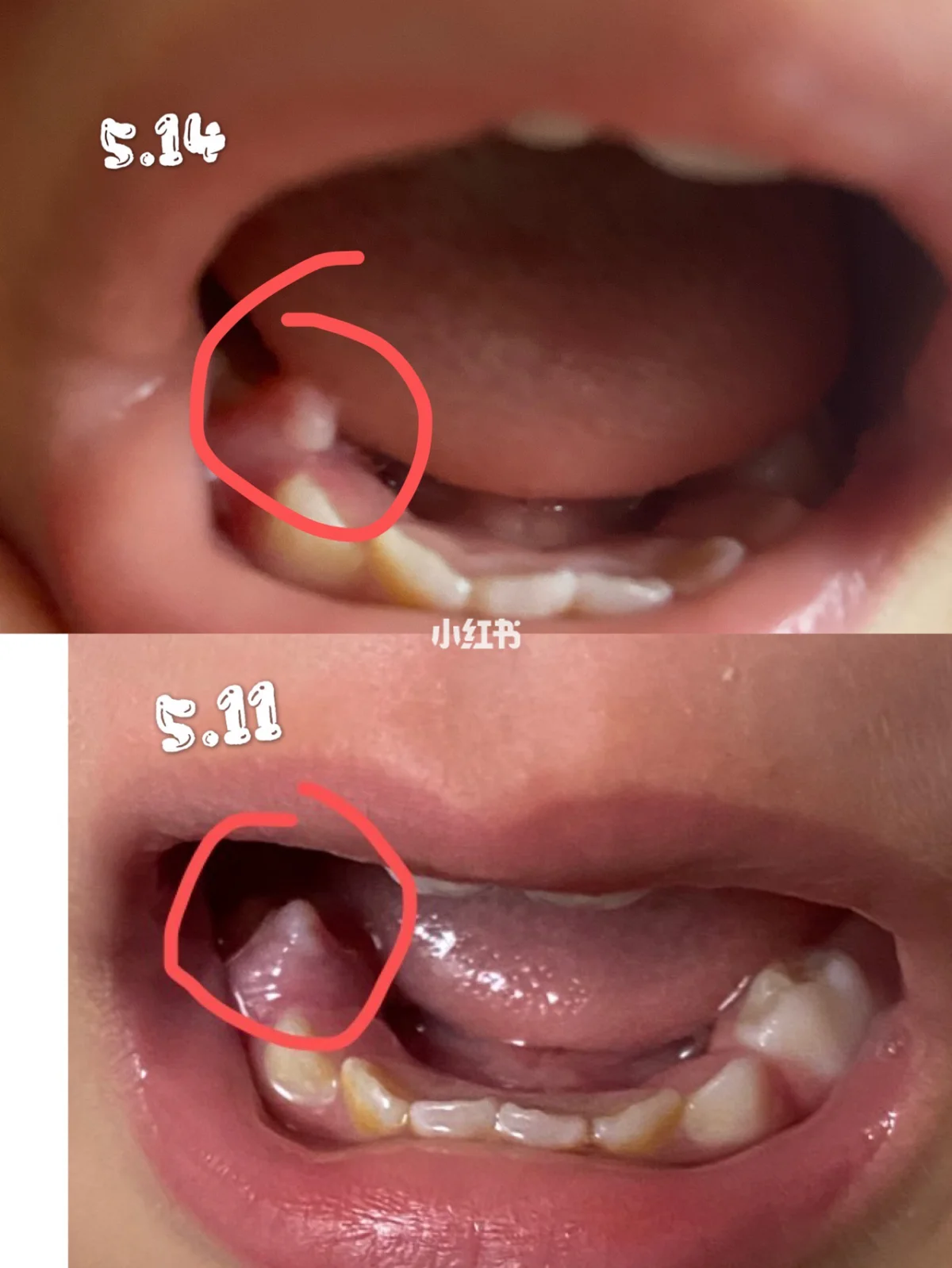 牙龈上面长了个小疙瘩