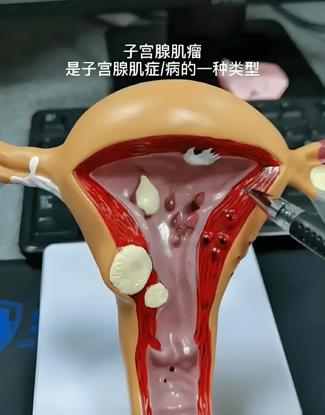 子宫腺肌病会癌变吗