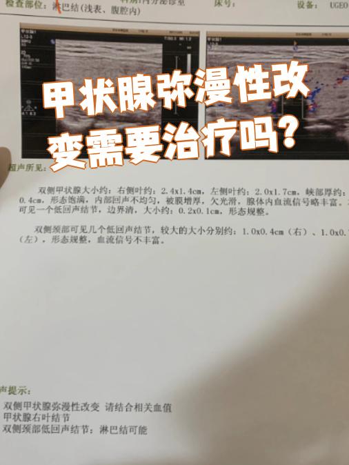 甲状腺弥漫性肿大严重吗?