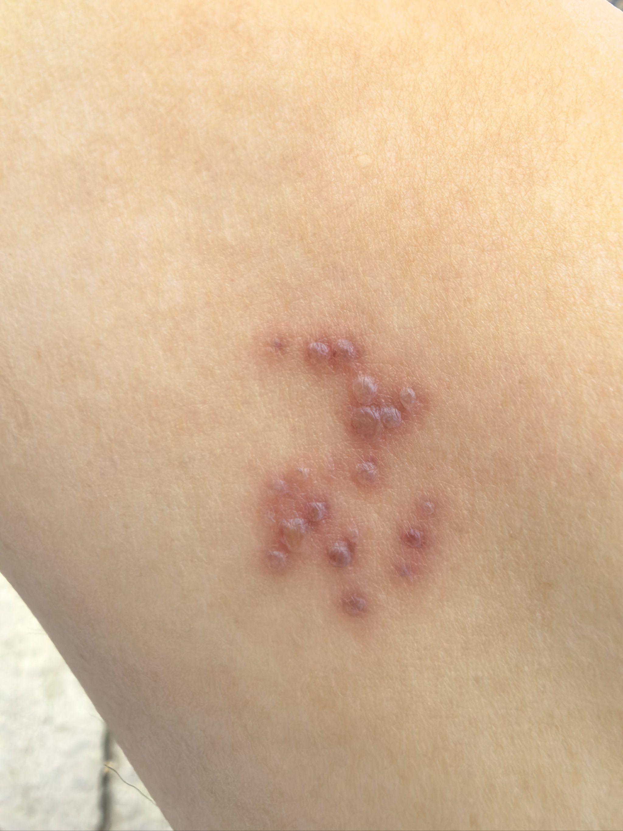 一热身体就像针扎一样痒