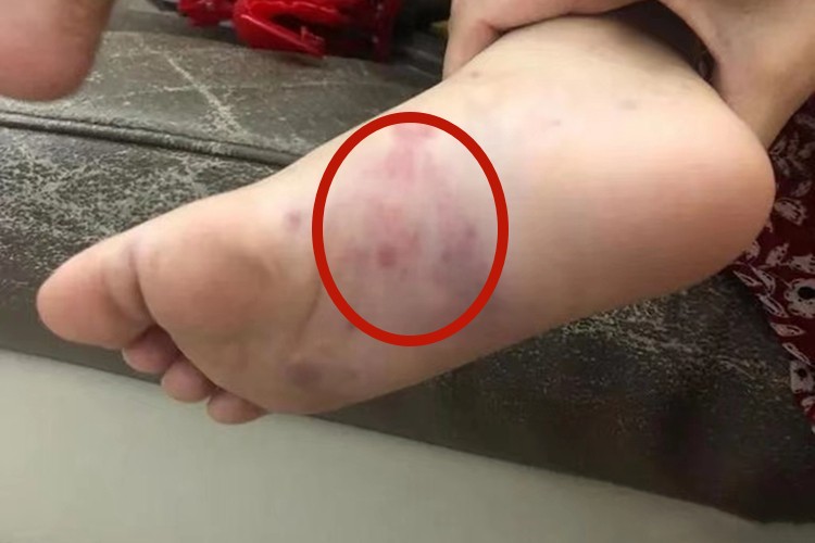 血小板低有哪些症状