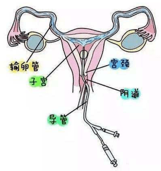 输卵管造影的过程?