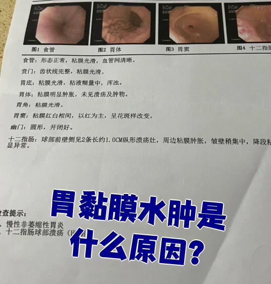 胃窦炎的症状都有哪些?